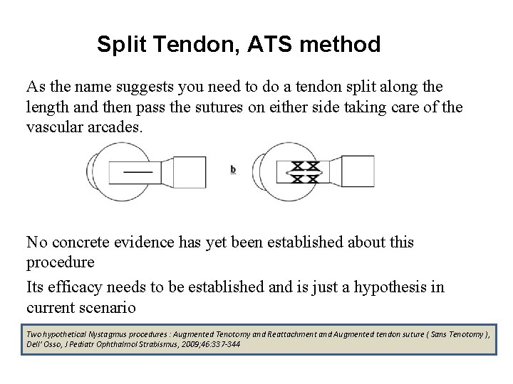 Split Tendon, ATS method As the name suggests you need to do a tendon