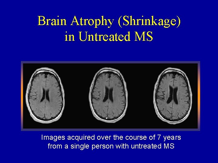Brain Atrophy (Shrinkage) in Untreated MS Images acquired over the course of 7 years
