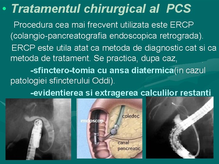  • Tratamentul chirurgical al PCS Procedura cea mai frecvent utilizata este ERCP (colangio-pancreatografia