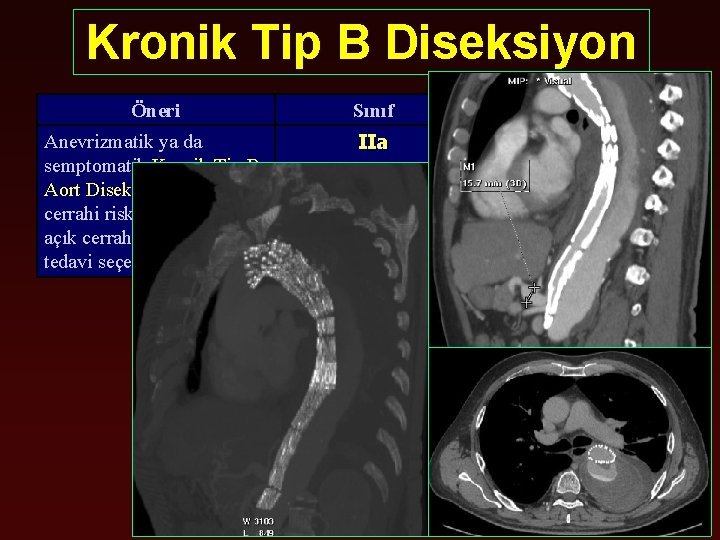 Kronik Tip B Diseksiyon Öneri Sınıf Kanıt Seviyesi Anevrizmatik ya da semptomatik Kronik Tip