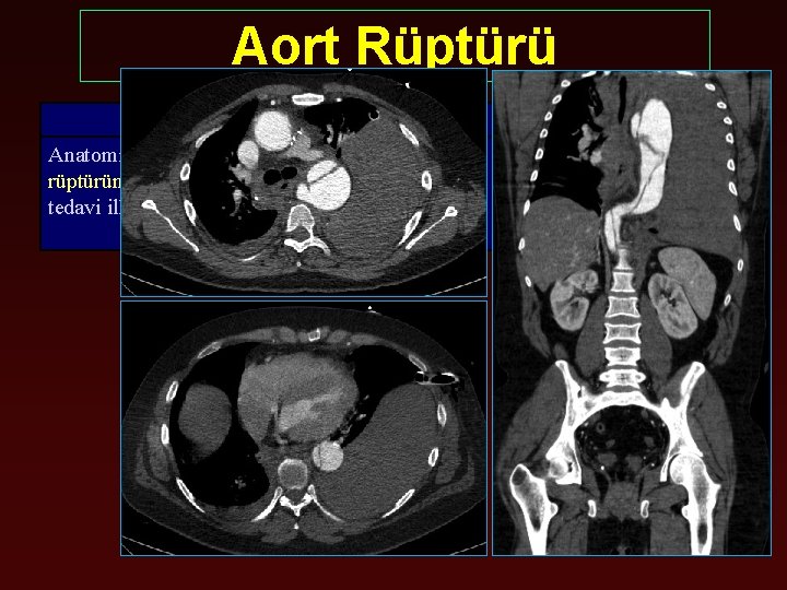 Aort Rüptürü Öneri Sınıf Kanıt Seviyesi Anatomi uygun ise Aort rüptüründe Endovasküler tedavi ilk