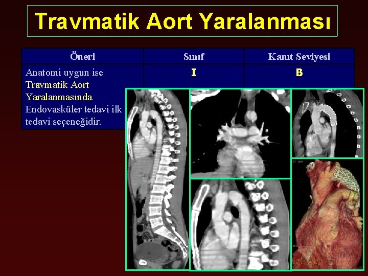 Travmatik Aort Yaralanması Öneri Anatomi uygun ise Travmatik Aort Yaralanmasında Endovasküler tedavi ilk tedavi