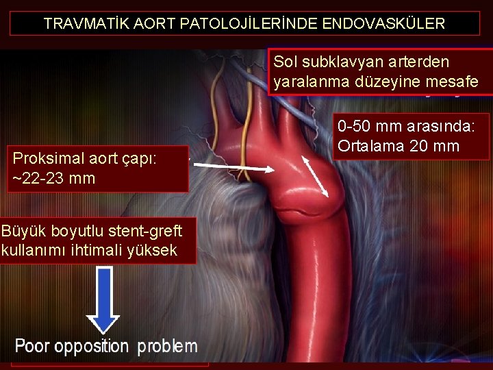 TRAVMATİK AORT PATOLOJİLERİNDE ENDOVASKÜLER Sol subklavyan arterden yaralanma düzeyine mesafe Proksimal aort çapı: ~22