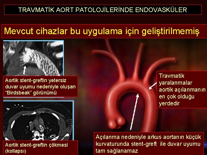 TRAVMATİK AORT PATOLOJİLERİNDE ENDOVASKÜLER Mevcut cihazlar bu uygulama için geliştirilmemiş Aortik stent-greftin yetersiz duvar