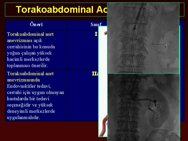 Torakoabdominal Aort Anevrizması Öneri Torakoabdominal aort anevrizması açık cerrahisinin bu konuda yoğun çalışan yüksek