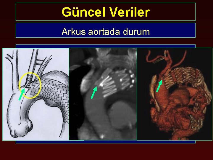 Güncel Veriler Arkus aortada durum Arkusda TEVAR • Çok farklı patolojiler • Hasta faktörleri