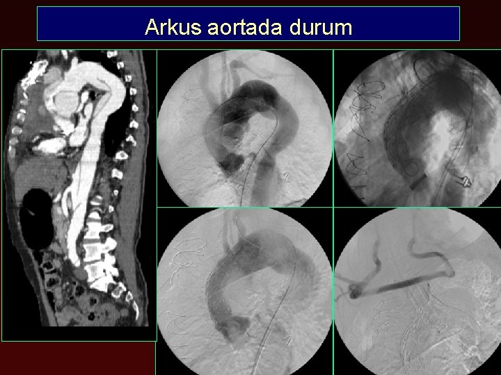 Arkus aortada durum 
