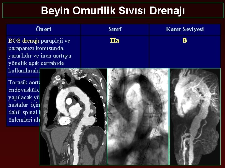 Beyin Omurilik Sıvısı Drenajı Öneri Sınıf Kanıt Seviyesi BOS drenajı parapleji ve paraparezi konusunda