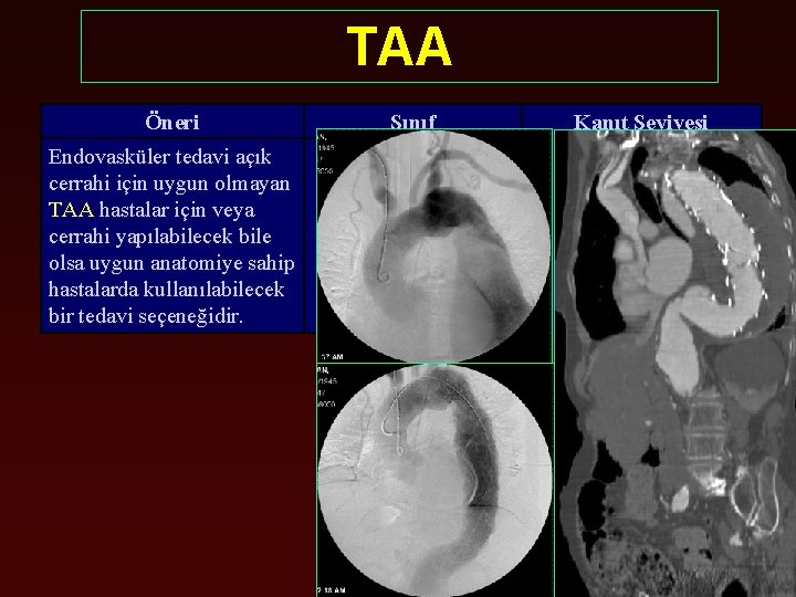 TAA Öneri Sınıf Kanıt Seviyesi Endovasküler tedavi açık cerrahi için uygun olmayan TAA hastalar
