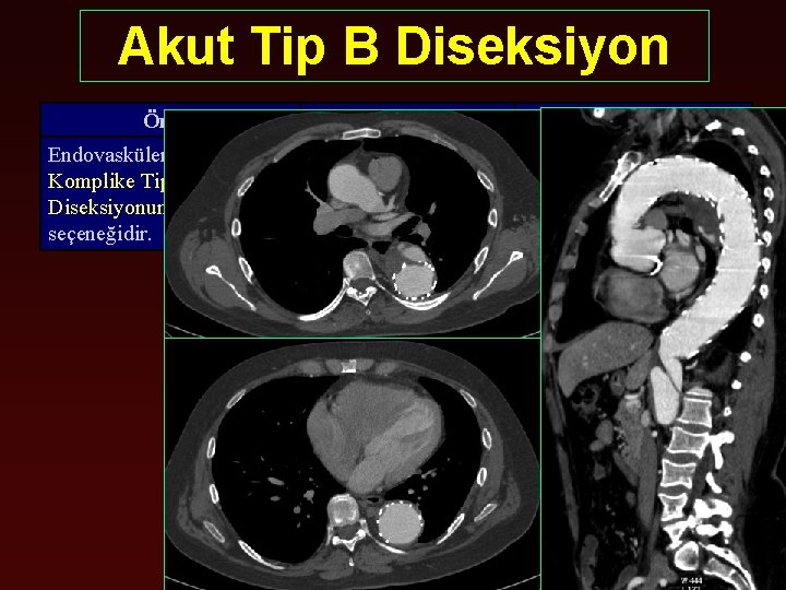 Akut Tip B Diseksiyon Öneri Endovasküler tedavi Akut Komplike Tip B Aort Diseksiyonunda ilk