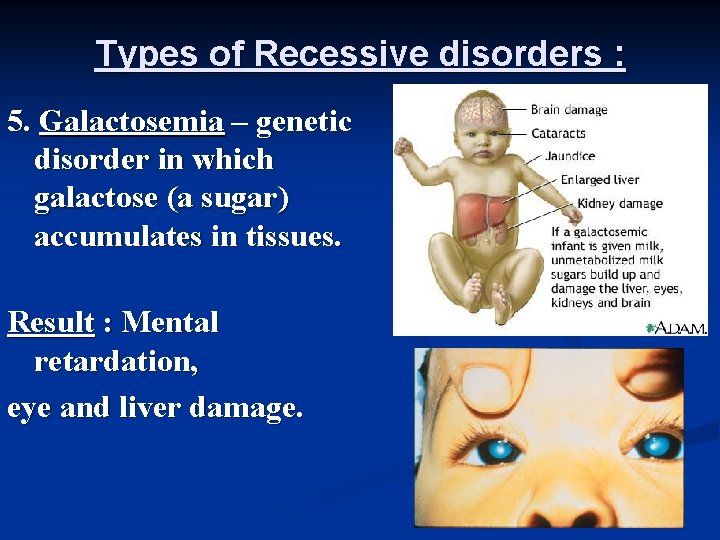 Types of Recessive disorders : 5. Galactosemia – genetic disorder in which galactose (a