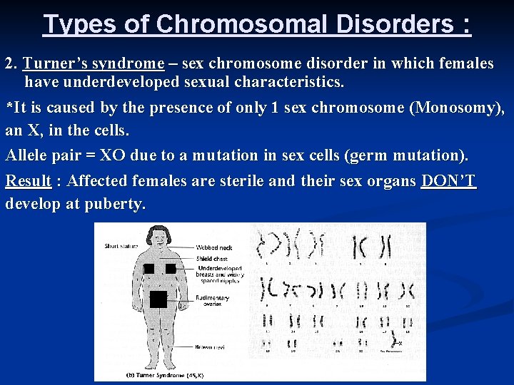 Types of Chromosomal Disorders : 2. Turner’s syndrome – sex chromosome disorder in which