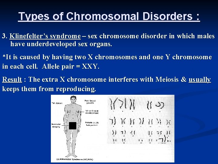 Types of Chromosomal Disorders : 3. Klinefelter’s syndrome – sex chromosome disorder in which
