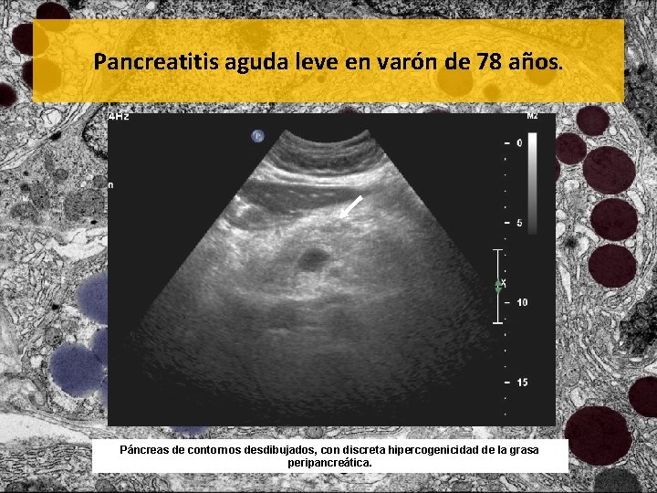 Pancreatitis aguda leve en varón de 78 años. Páncreas de contornos desdibujados, con discreta
