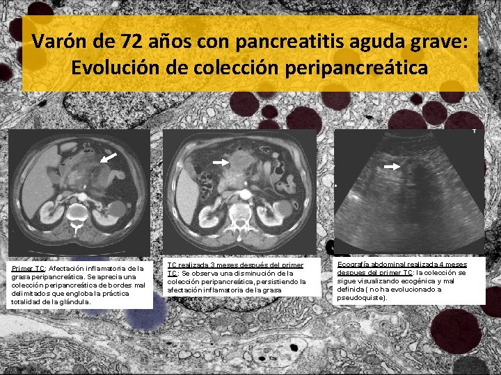 Varón de 72 años con pancreatitis aguda grave: Evolución de colección peripancreática Primer TC: