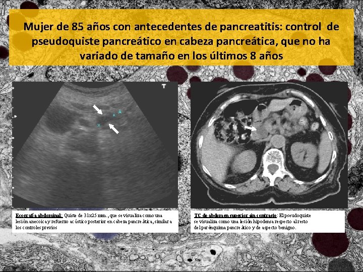 Mujer de 85 años con antecedentes de pancreatitis: control de pseudoquiste pancreático en cabeza