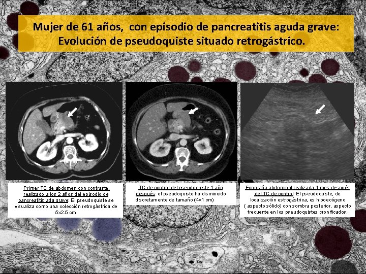 Mujer de 61 años, con episodio de pancreatitis aguda grave: Evolución de pseudoquiste situado