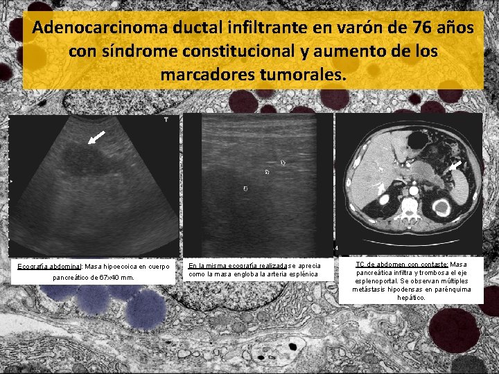 Adenocarcinoma ductal infiltrante en varón de 76 años con síndrome constitucional y aumento de