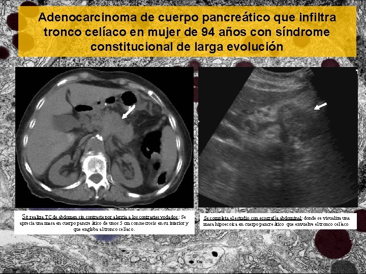Adenocarcinoma de cuerpo pancreático que infiltra tronco celíaco en mujer de 94 años con