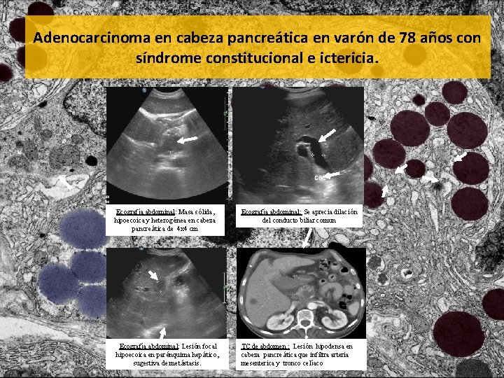 Adenocarcinoma en cabeza pancreática en varón de 78 años con síndrome constitucional e ictericia.