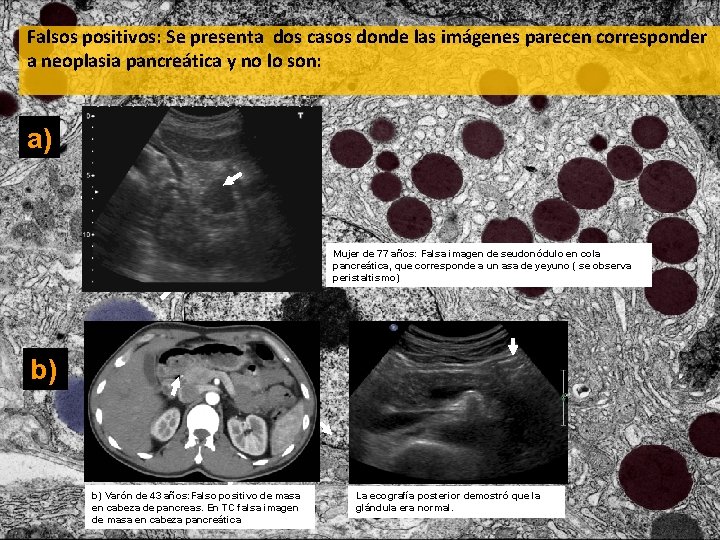 Falsos positivos: Se presenta dos casos donde las imágenes parecen corresponder a neoplasia pancreática