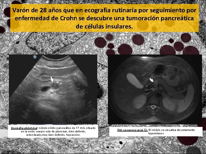 Varón de 28 años que en ecografía rutinaria por seguimiento por enfermedad de Crohn