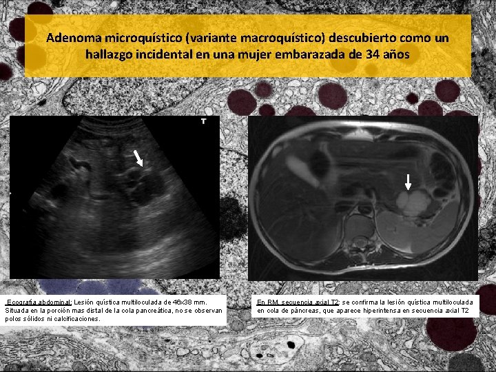Adenoma microquístico (variante macroquístico) descubierto como un hallazgo incidental en una mujer embarazada de