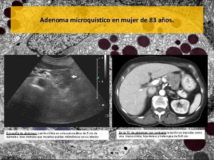 Adenoma microquístico en mujer de 83 años. Ecografía de abdomen: Lesión sólida en cola