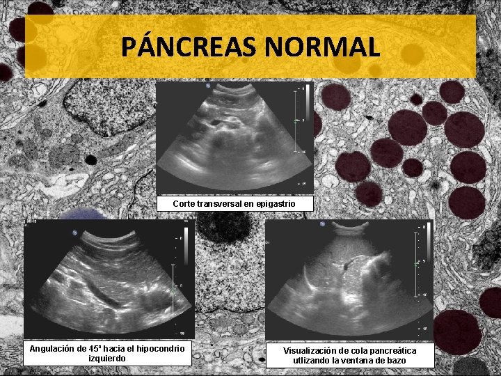 PÁNCREAS NORMAL Corte transversal en epigastrio Angulación de 45º hacia el hipocondrio izquierdo Visualización
