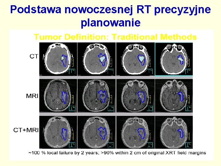 Podstawa nowoczesnej RT precyzyjne planowanie 