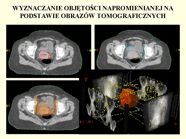 WYZNACZANIE OBJĘTOŚCI NAPROMIENIANEJ NA PODSTAWIE OBRAZÓW TOMOGRAFICZNYCH CTV GTV PTV 