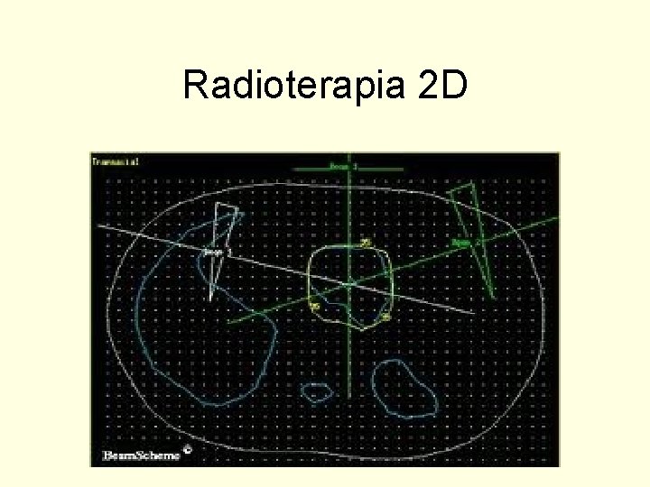 Radioterapia 2 D 