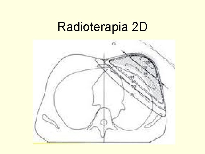 Radioterapia 2 D 