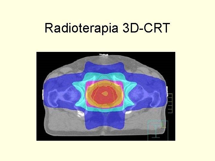 Radioterapia 3 D-CRT 