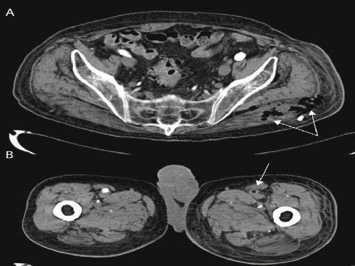 FIGURA 2. TC ABDOMINAL DE UN VARÓN DE 86 AÑOS, DIABÉTICO Y CON ANTECEDENTES