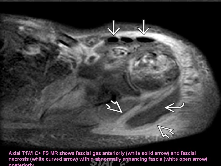 Axial T 1 WI C+ FS MR shows fascial gas anteriorly (white solid arrow)