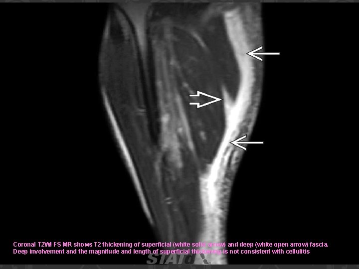 Coronal T 2 WI FS MR shows T 2 thickening of superficial (white solid