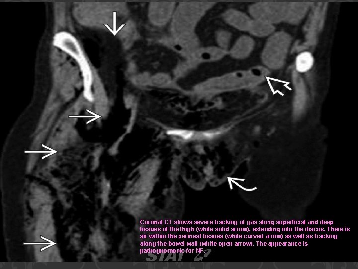 Coronal CT shows severe tracking of gas along superficial and deep tissues of the