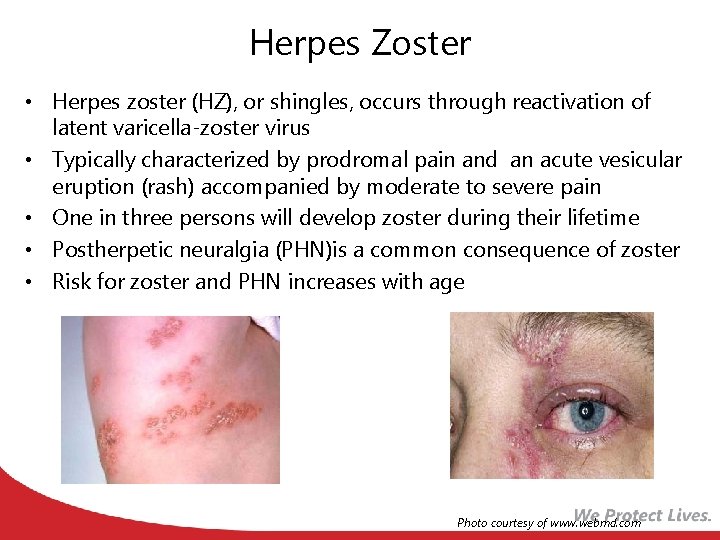 Herpes Zoster • Herpes zoster (HZ), or shingles, occurs through reactivation of latent varicella-zoster