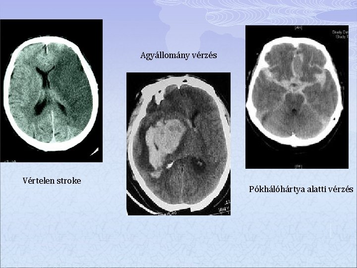 Agyállomány vérzés Vértelen stroke Pókhálóhártya alatti vérzés 