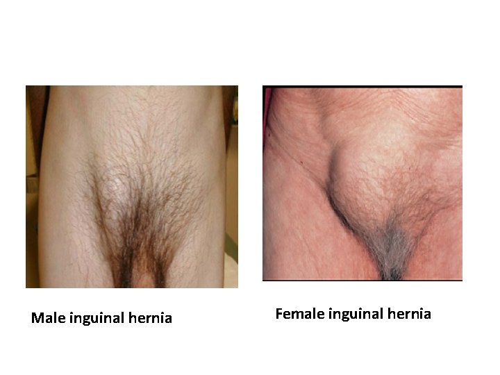 Male inguinal hernia Female inguinal hernia 