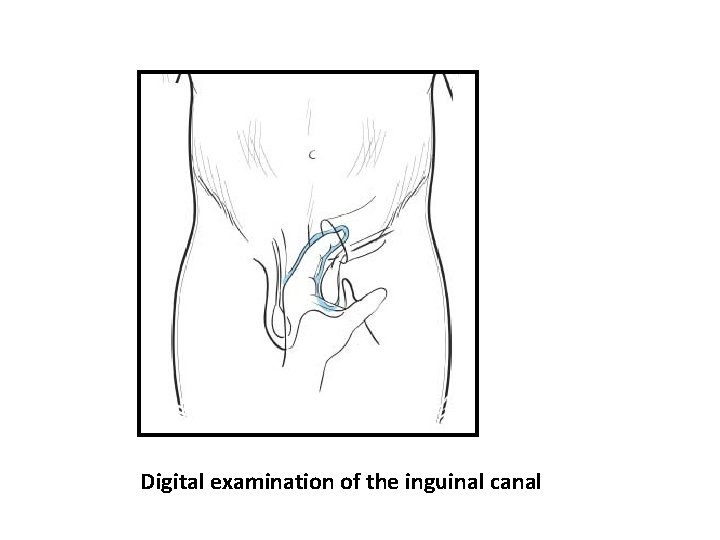Digital examination of the inguinal canal 