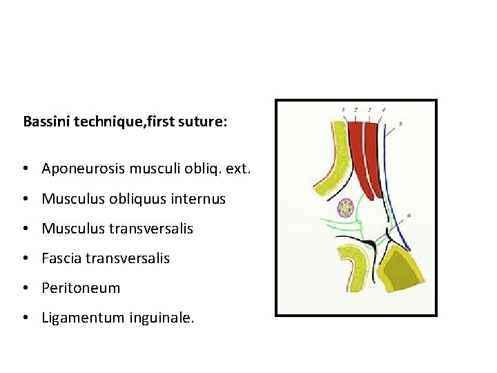 Bassini technique, first suture: • Aponeurosis musculi obliq. ext. • Musculus obliquus internus •