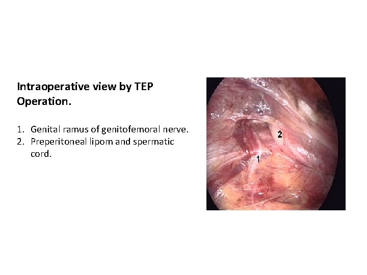 Intraoperative view by TEP Operation. 1. Genital ramus of genitofemoral nerve. 2. Preperitoneal lipom
