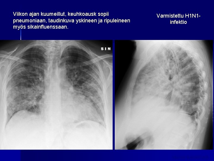 Viikon ajan kuumeillut, keuhkoausk sopii pneumoniaan, taudinkuva yskineen ja ripuleineen myös sikainfluenssaan. Varmistettu H