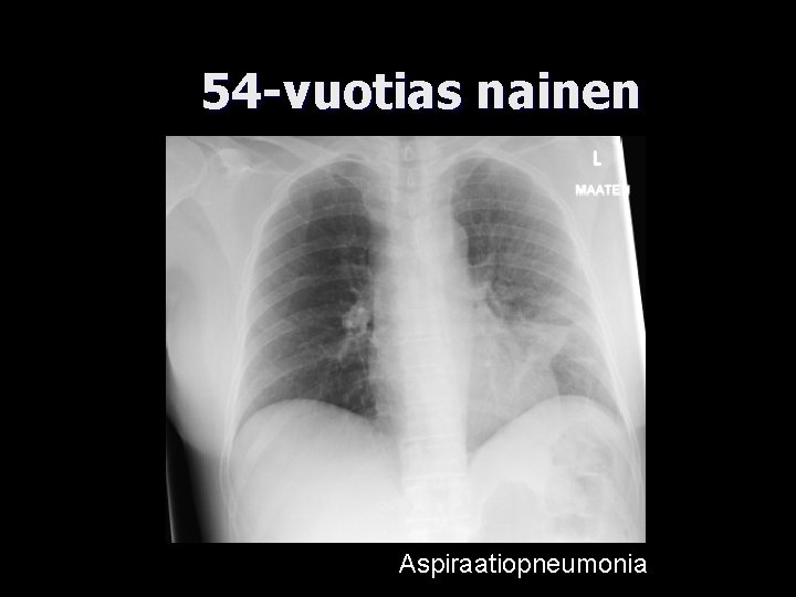 54 -vuotias nainen Aspiraatiopneumonia 