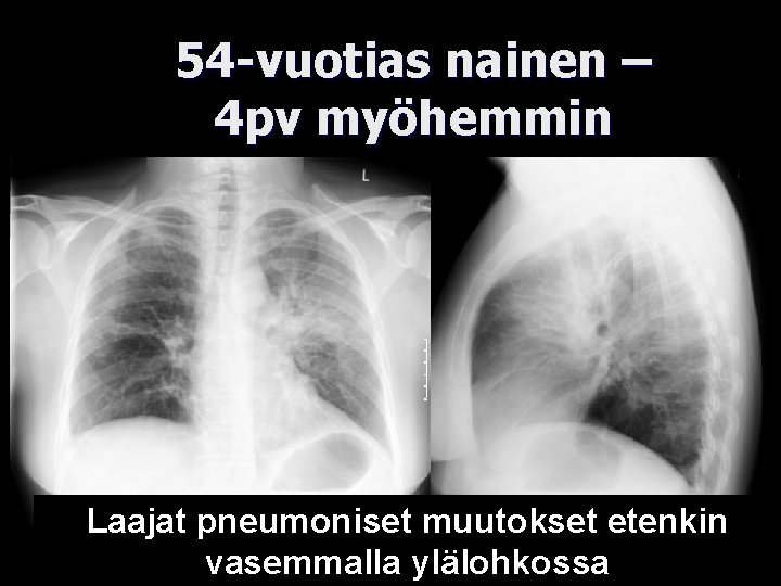 54 -vuotias nainen – 4 pv myöhemmin Laajat pneumoniset muutokset etenkin vasemmalla ylälohkossa 