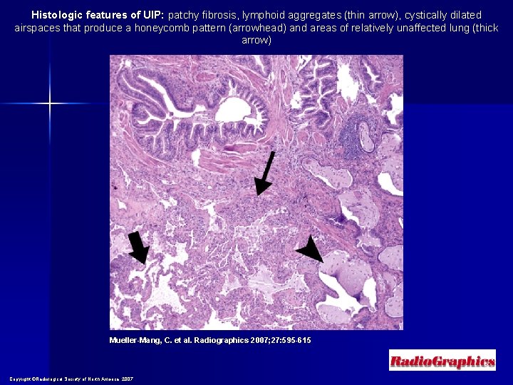 Histologic features of UIP: patchy fibrosis, lymphoid aggregates (thin arrow), cystically dilated airspaces that