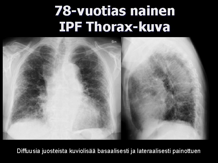 78 -vuotias nainen IPF Thorax-kuva Diffuusia juosteista kuviolisää basaalisesti ja lateraalisesti painottuen 