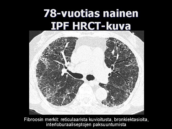 78 -vuotias nainen IPF HRCT-kuva Fibroosin merkit: reticulaarista kuvioitusta, bronkiektasioita, interloburaaliseptojen paksuuntumista 
